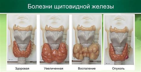 Предупреждение отклонений щитовидной железы у женщин