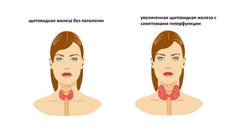 Предупреждение повышенного ТТГ у женщин