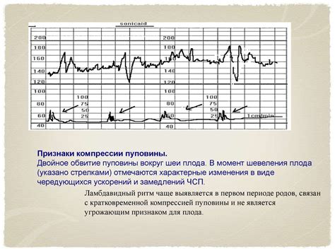 Преимущества диагностики схваток с помощью КТГ