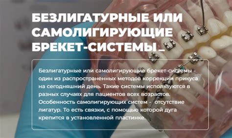 Преимущества и особенности системы самолигирующих брекетов Дантистофф