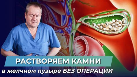 Преимущества и риски удаления камней в желчном пузыре: