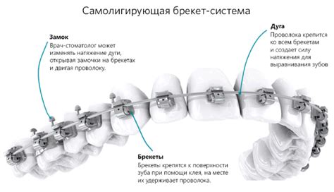 Преимущества самолигирующих брекетов Дантистофф