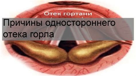 Признаки гноевого отека горла