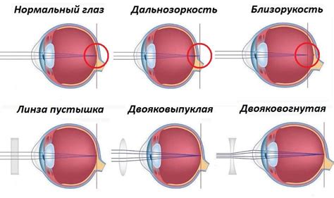 Признаки и симптомы после лазерной коррекции