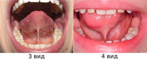 Признаки короткой уздечки языка