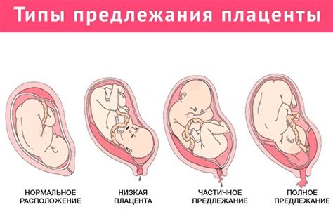 Признаки предлежания плаценты