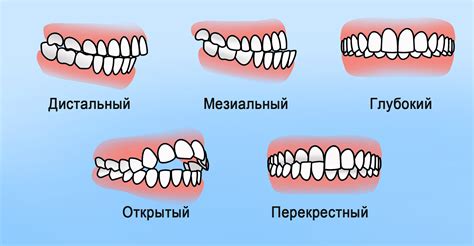 Прикус и его связь с ранним формированием речи