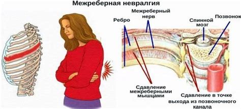 Применение Мовалиса как профилактическое средство