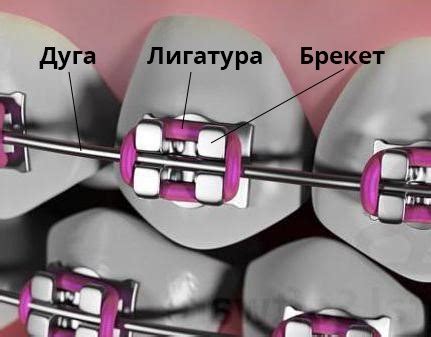 Принципы работы брекетов