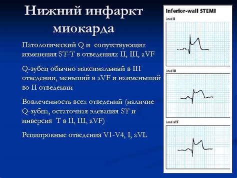 Принцип работы Миокарда Холтера: Этапы и Преимущества