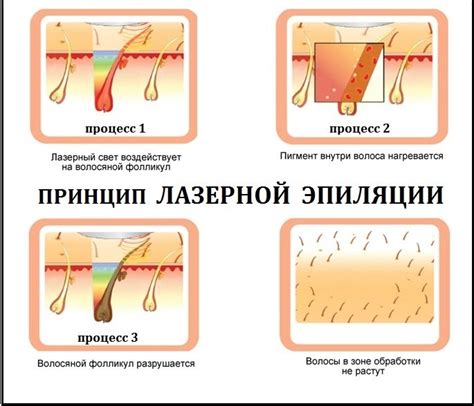 Принцип работы лазерной эпиляции