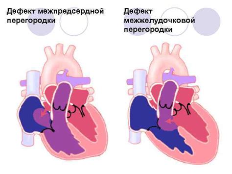 Причины возникновения ДМЖП у ребенка