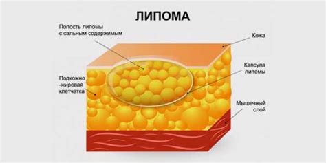 Причины возникновения липомы