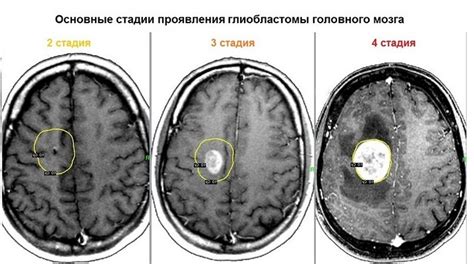 Причины возникновения опухоли на месте татуировки