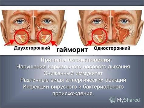 Причины возникновения полипов