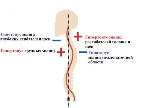 Причины выпирающих лопаток