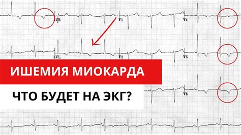 Причины для повторной ЭКГ: остерегайтесь пренебрегать