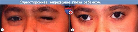 Причины закрывания ребенком одного глаза