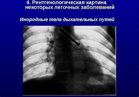 Причины заполнения бронхов мокротой