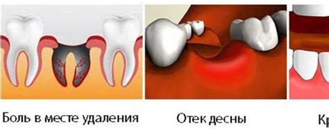 Причины затяжного заживления десен после удаления зубов