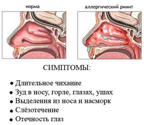 Причины и симптомы отека носа