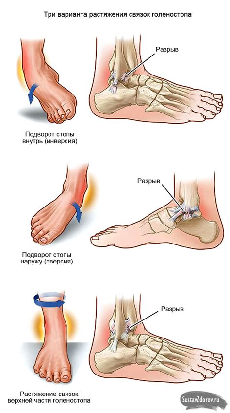 Причины и симптомы растяжения связок голеностопа