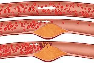 Причины кальцинирования сосудов