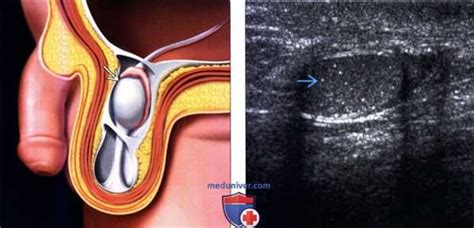 Причины неопущения яичка