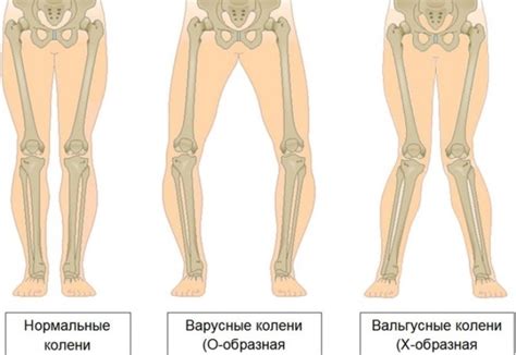 Причины неравномерного размера ног у взрослых