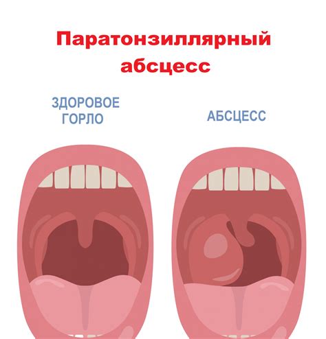 Причины образования и проблемы гланд