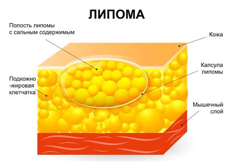 Причины образования липом на теле