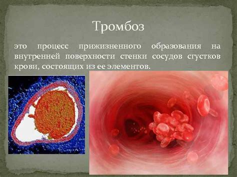 Причины образования сгустков крови