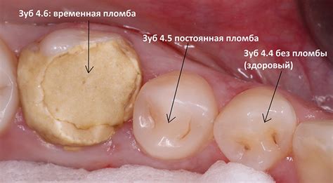 Причины отека десен после временной пломбы