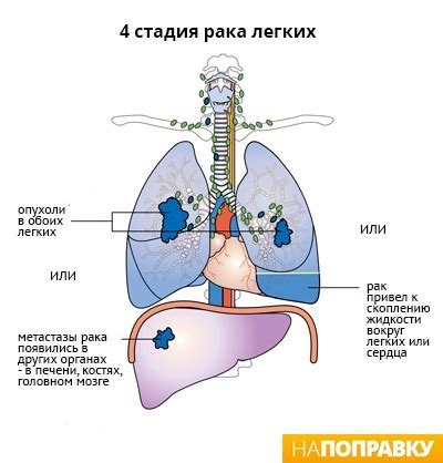 Причины повышения температуры при раке легких