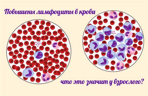 Причины повышенного уровня лимфоцитов