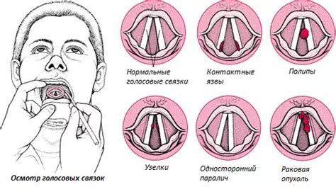 Причины подрезки голосовых связок