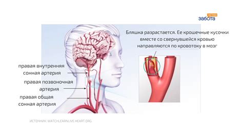 Причины разрыва сосуда в голове