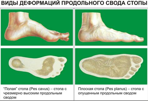 Причины сводов икры и стопы ног