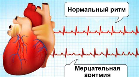 Причины тяжелого дыхания при мерцательной аритмии