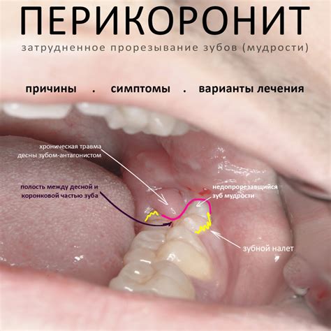 Причины удаления и их последствия