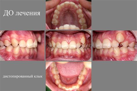 Проблема острой формы клыков