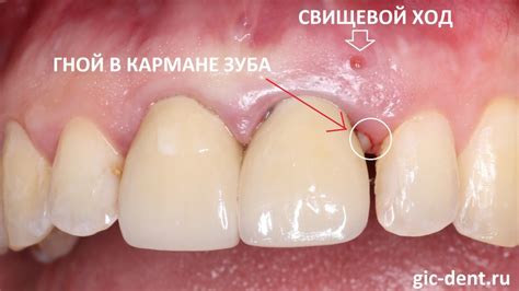 Проведение самостоятельной помощи при свище на десне