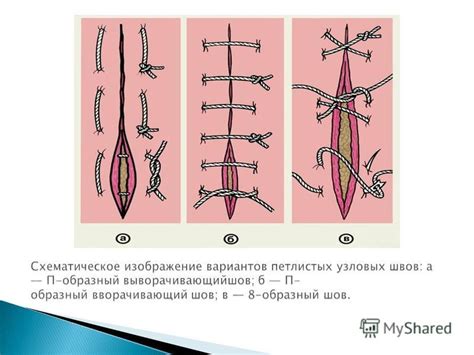 Проведение шва