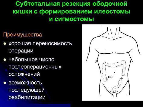 Продолжительность функционирования илеостомы после операции