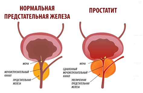 Простатит как расстройство мочевой системы