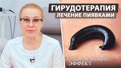 Простые домашние способы удаления пиявки