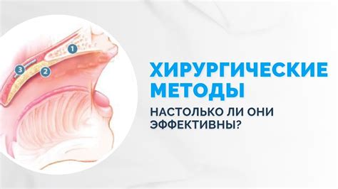 Профессиональные методы лечения храпа: от консультаций специалистов до хирургических вмешательств