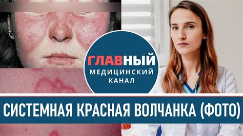 Профилактика красной волчанки