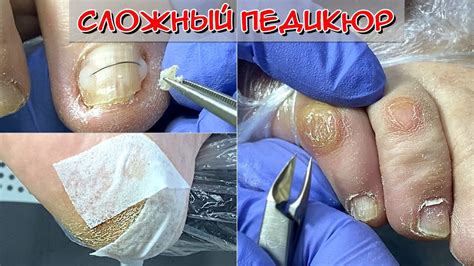 Профилактика мозолей на мизинце ноги