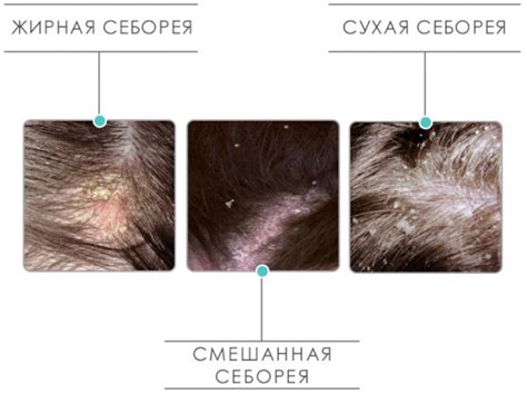 Профилактика сухости кожи головы